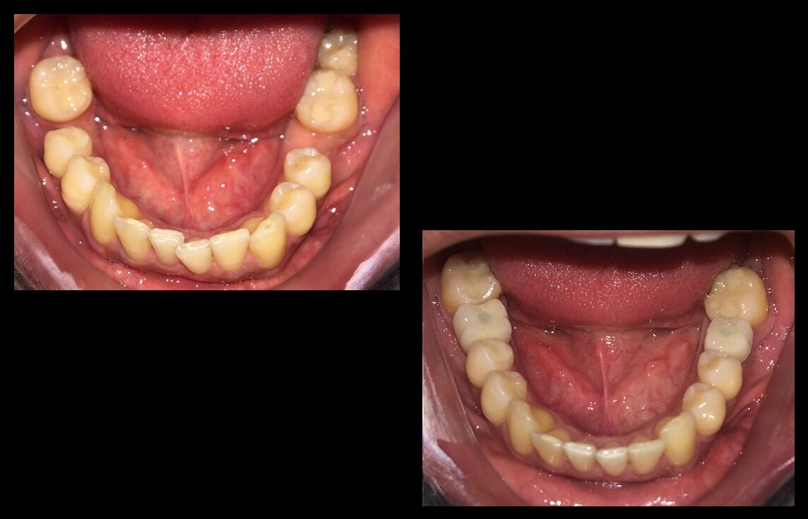 Antes e depois de implante dentário