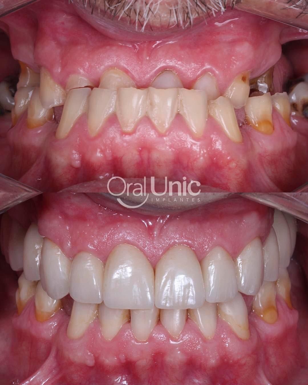 Antes e depois de implante dentário