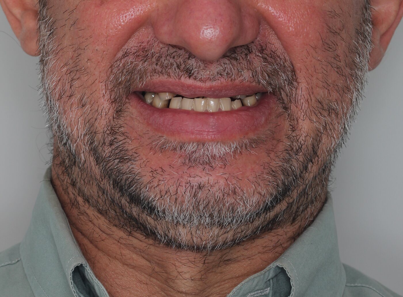 Antes do implante dentário
