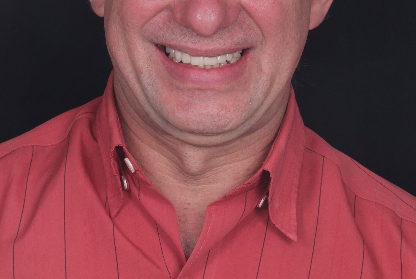 Antes do implante dentário