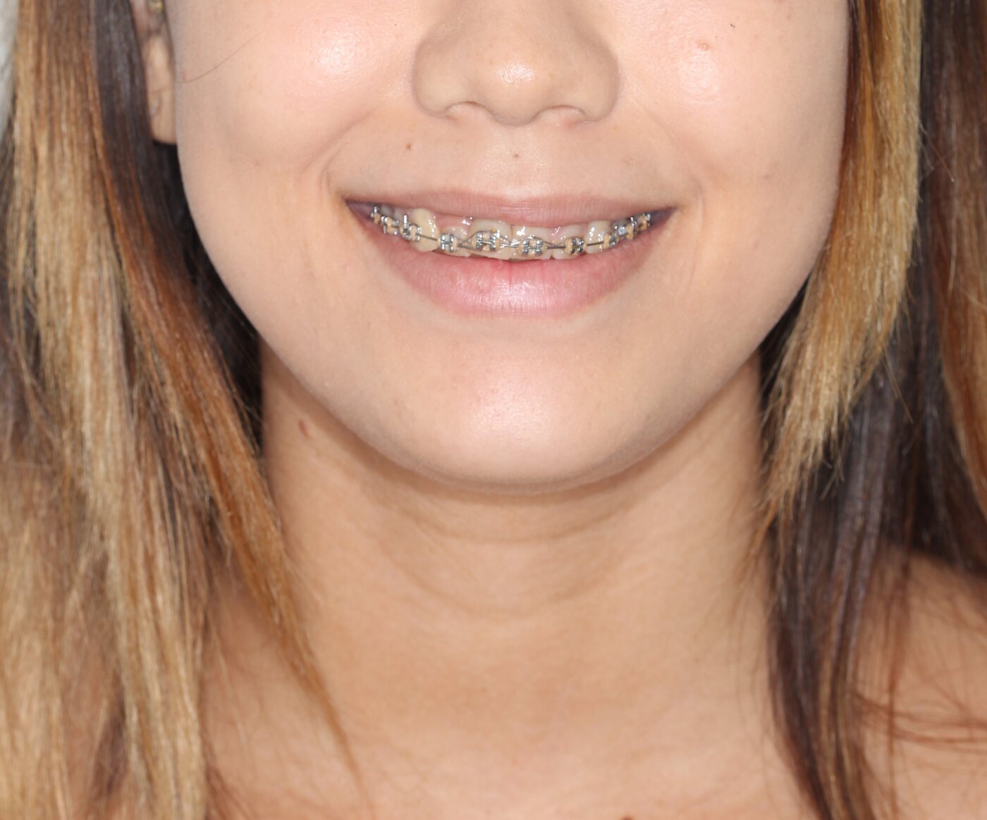 Antes das lentes de contato dental
