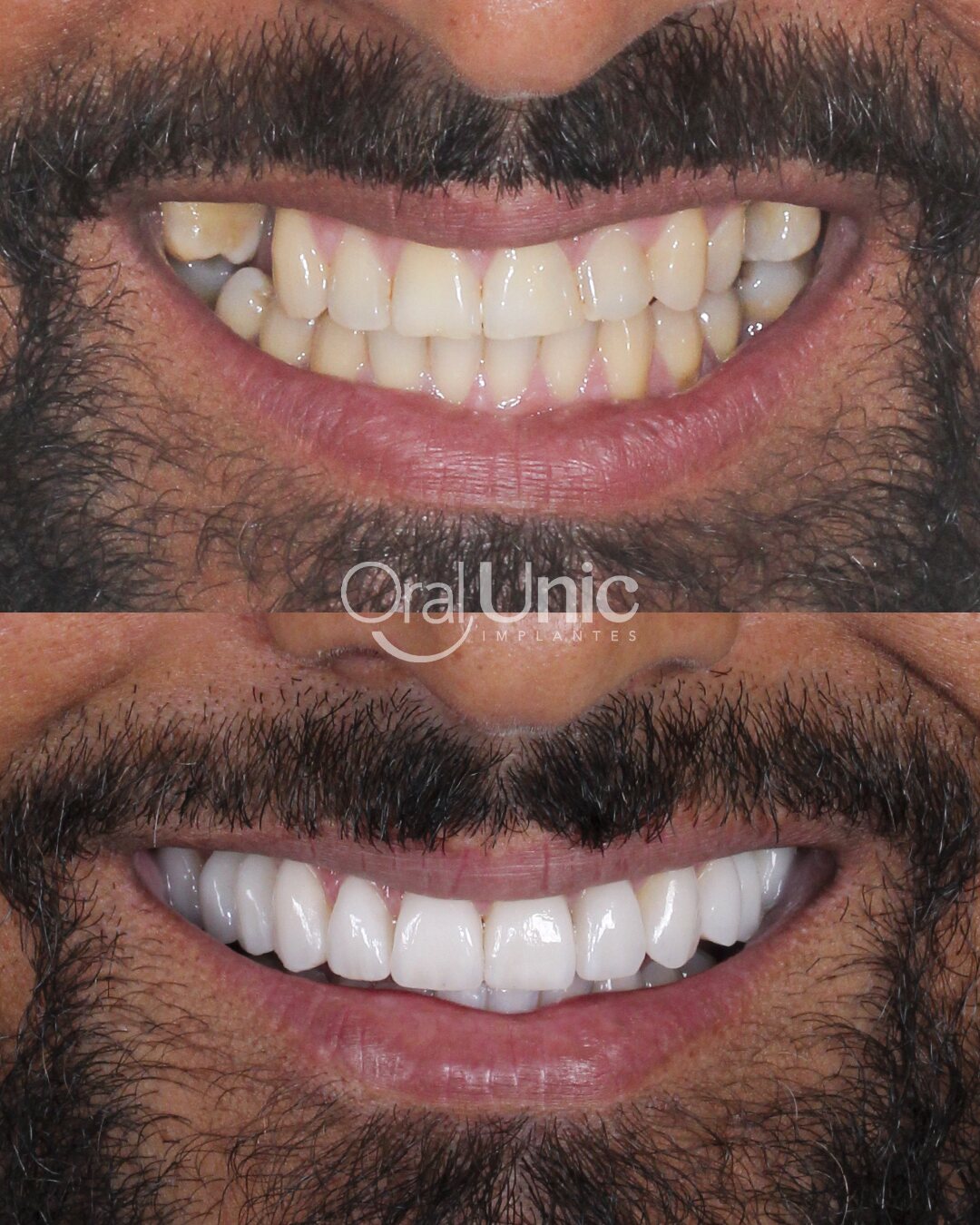 Antes e depois de lentes de contato dental