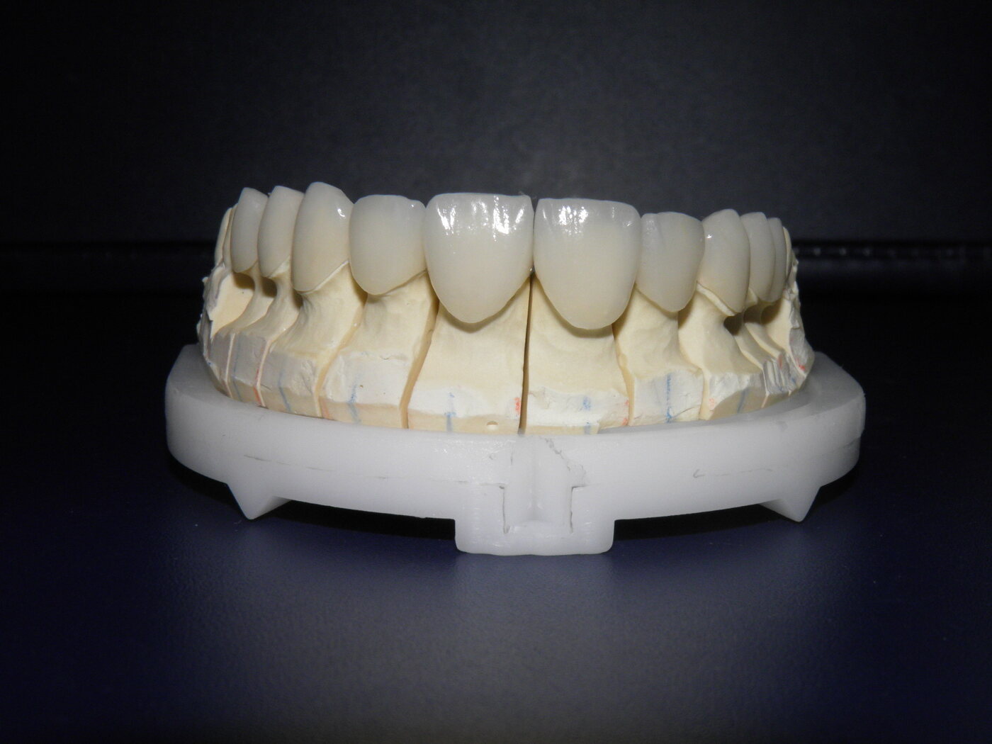 Antes das lentes de contato dental — Fabiano