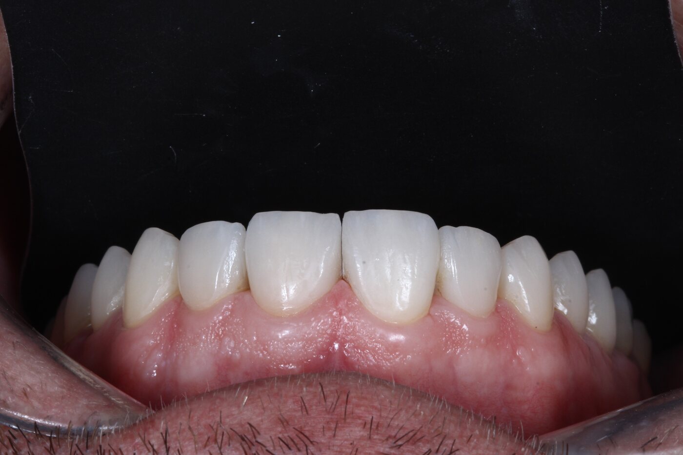 Depois das lentes de contato dental — Fabiano, 10 anos