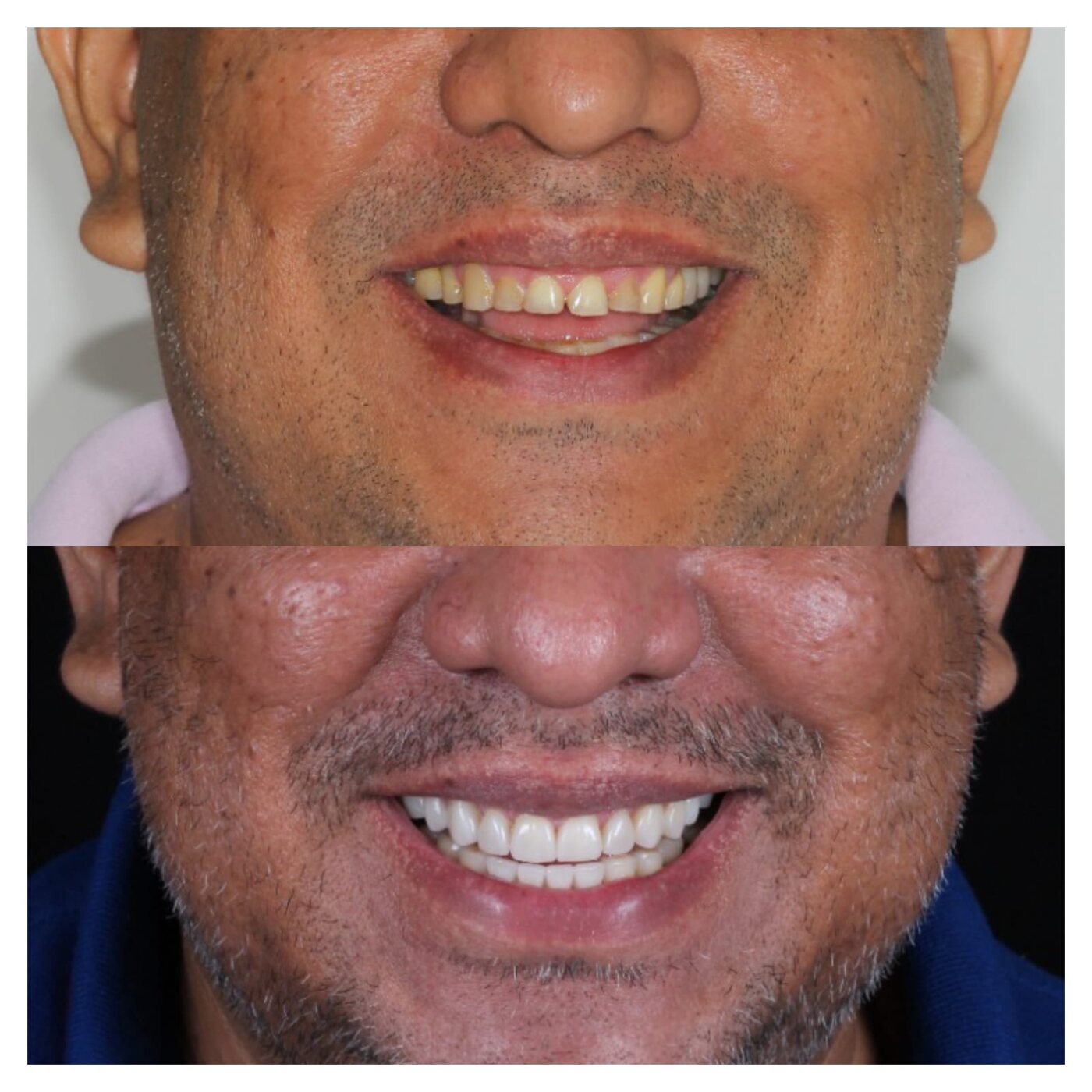 Antes e depois de lentes de contato dental — paciente Joel