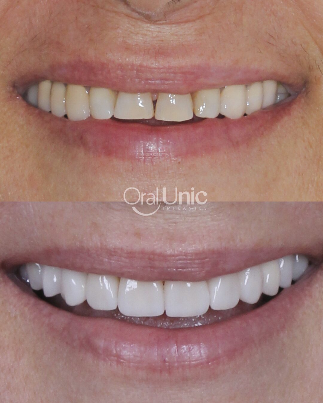 Antes e depois de lentes de contato dental — paciente Luiza