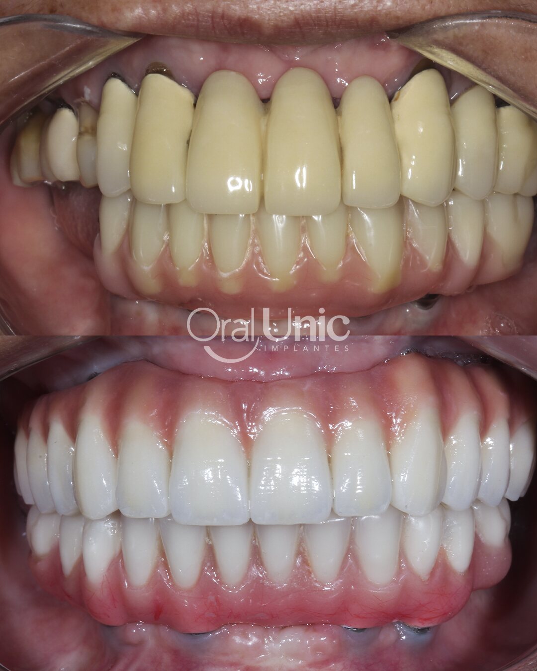 Antes e depois de protocolo de implante — paciente Edna